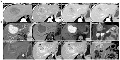 Case report: Recurrence of primary hepatic neuroendocrine tumors after resection of liver segments IV in 8 years follow-up